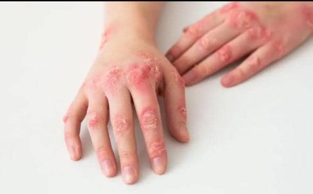 Indwara ya mburugu yandurira mu mibonano mpuzabitsina, byinshi abantu batayiziho, yishe benshi