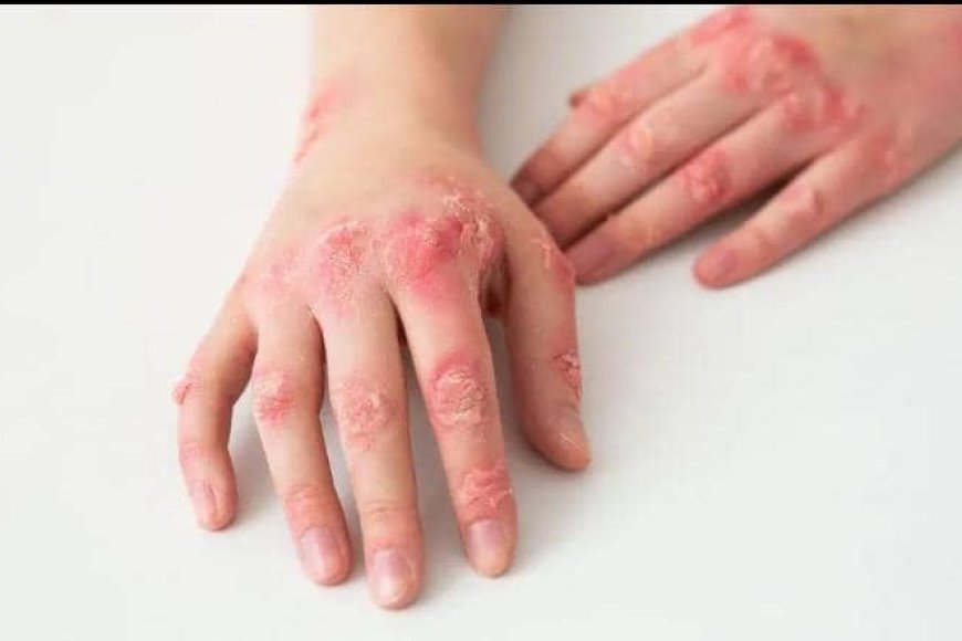 Indwara ya mburugu yandurira mu mibonano mpuzabitsina, byinshi abantu batayiziho, yishe benshi