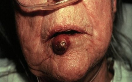 Ibimenyetso 10 byakwereka ko urwaye kanseri utiriwe ujya kwa muganga