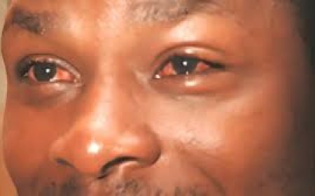 Ihutire kwivuza no kwirinda ugitangira kubona ibi bimenyetso bishobora kugutera icyorezo cy’amaso