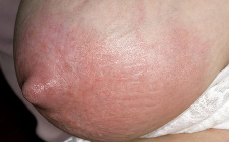 Menya indwara itera ububabare bw’amabere yitwa Mistitis