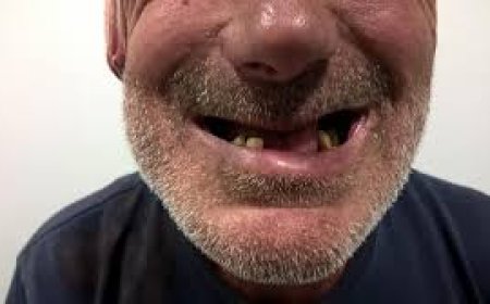 Dore impamvu udakwiye gukura amenyo uko wiboneye cyane ko bitera ubumuga bwo mu kanwa