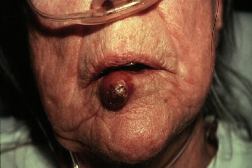 Ibimenyetso 10 byakwereka ko urwaye kanseri utiriwe ujya kwa muganga