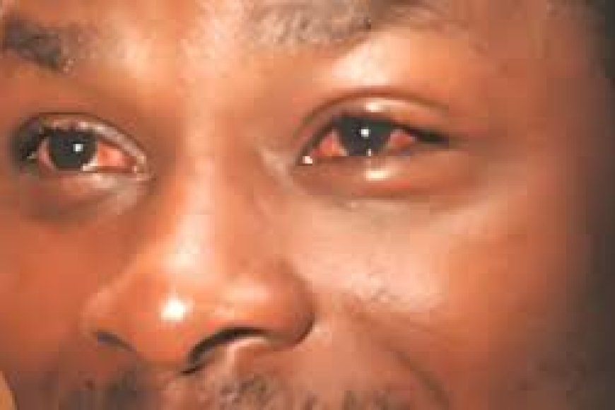 Ihutire kwivuza no kwirinda ugitangira kubona ibi bimenyetso bishobora kugutera icyorezo cy’amaso