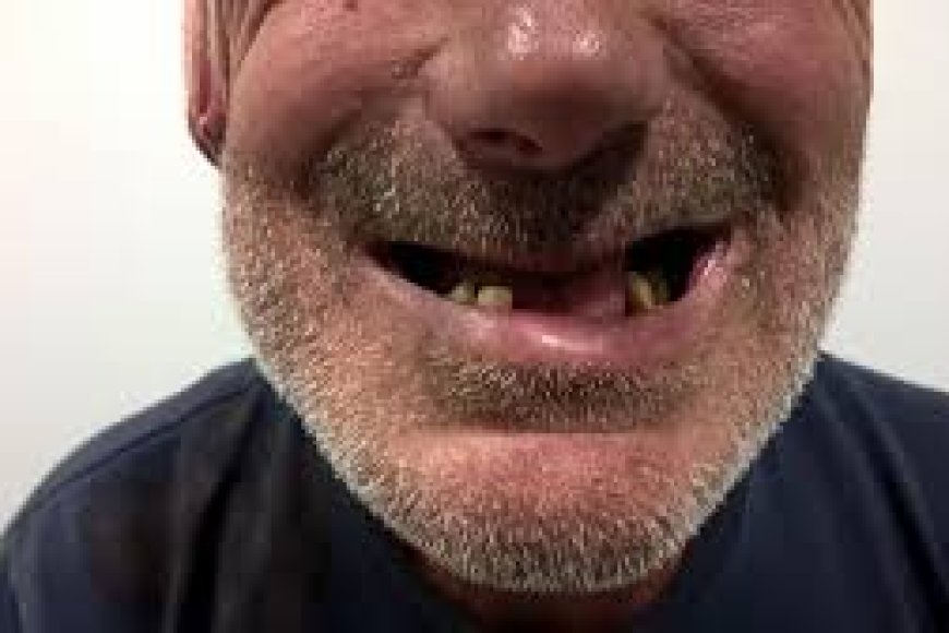 Dore impamvu udakwiye gukura amenyo uko wiboneye cyane ko bitera ubumuga bwo mu kanwa