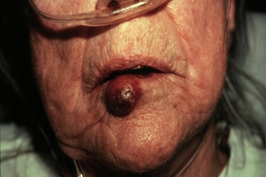 Ibimenyetso 10 byakwereka ko urwaye kanseri utiriwe ujya kwa muganga