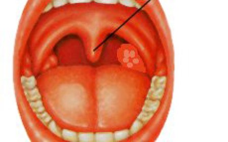 Byinshi wamenya ku ndwara y'ikirimi n’ikirato zikunze kuzahaza abana