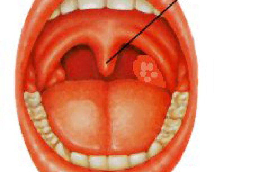 Byinshi wamenya ku ndwara y'ikirimi n’ikirato zikunze kuzahaza abana