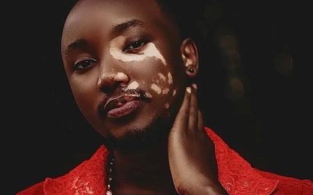 Imyidagaduro: Umuhanzi ugezweho mu muziki wagize ikibazo cy’uruhu yagaragaje ko yakomeje kurwara, anavuga inkuru afitiye abakunzi-AMAFOTO