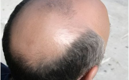 Ibihugu byambere ku Isi biza ku isonga mu kugira abagabo benshi bafite uruhara