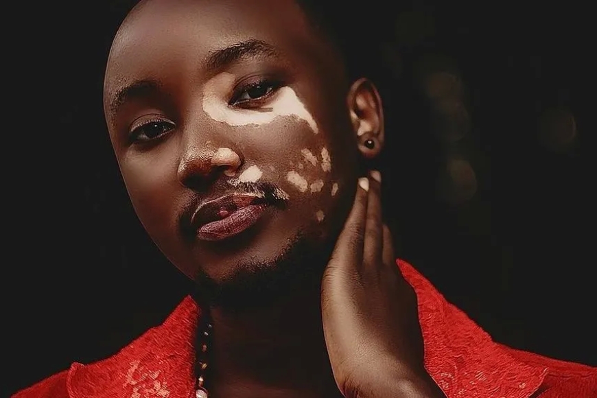 Imyidagaduro: Umuhanzi ugezweho mu muziki wagize ikibazo cy’uruhu yagaragaje ko yakomeje kurwara, anavuga inkuru afitiye abakunzi-AMAFOTO