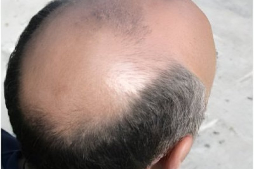 Ibihugu byambere ku Isi biza ku isonga mu kugira abagabo benshi bafite uruhara