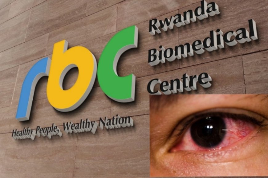 Kubera ikibazo cy'indwara y'amaso y'amarundi ari kwibasira abanyarwanda batari bake, RBC irasaba ko niba wibonyeho ibi bimenyetso, irinde kujya mu bantu