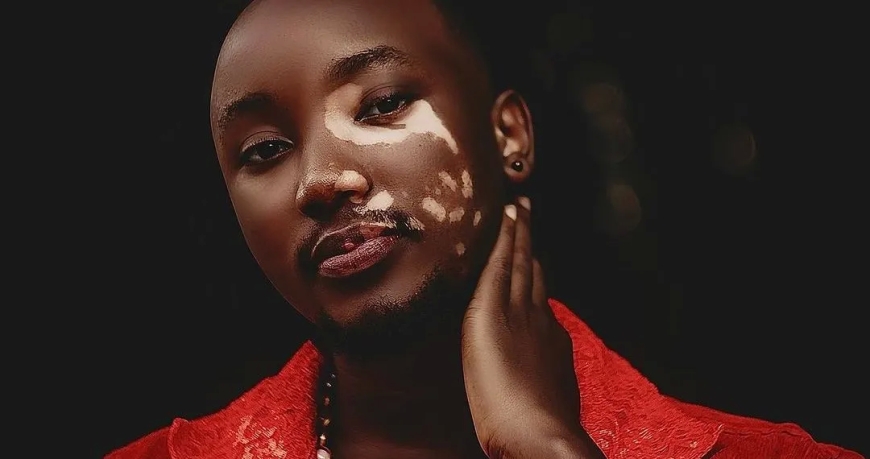 Imyidagaduro: Umuhanzi ugezweho mu muziki wagize ikibazo cy’uruhu yagaragaje ko yakomeje kurwara, anavuga inkuru afitiye abakunzi-AMAFOTO