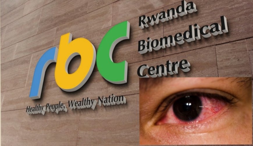 Kubera ikibazo cy'indwara y'amaso y'amarundi ari kwibasira abanyarwanda batari bake, RBC irasaba ko niba wibonyeho ibi bimenyetso, irinde kujya mu bantu