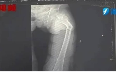 Ntibisanzwe! Umugabo w’imyaka 35 y’amavuko yakoroye avunika igufa ry’itako