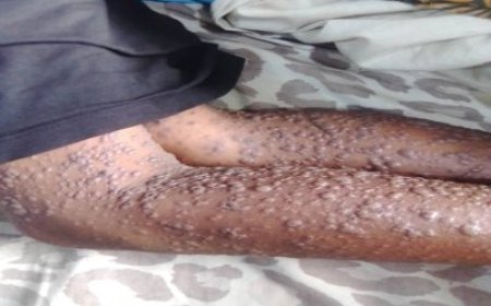 Burundi: Abaturage baratabaza nyuma yo guterwa n'icyorezo giteye ubwoba kibasira uruhu kikanafata imyanya y’ubuhumekero