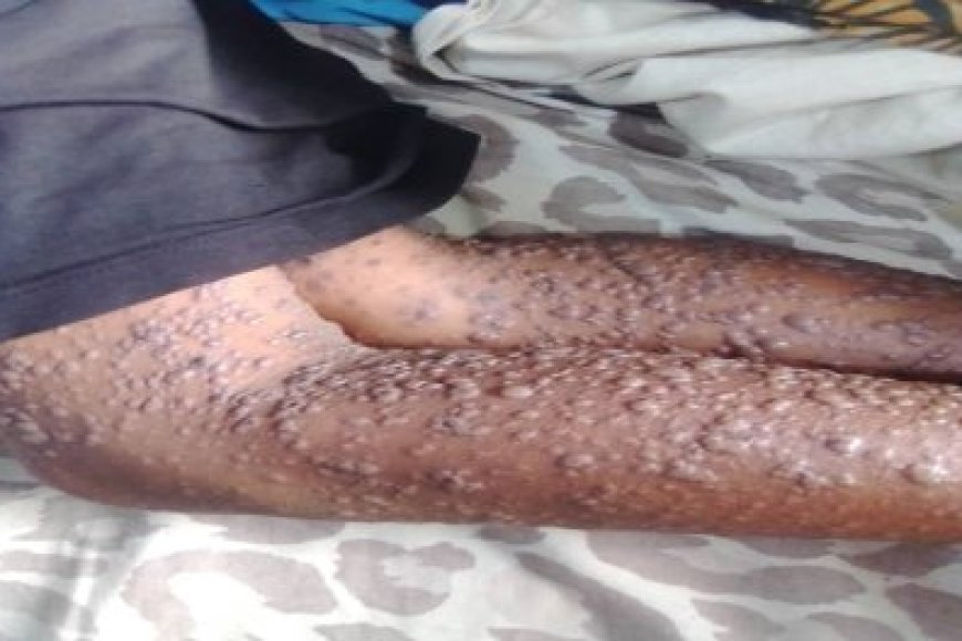 Burundi: Abaturage baratabaza nyuma yo guterwa n'icyorezo giteye ubwoba kibasira uruhu kikanafata imyanya y’ubuhumekero