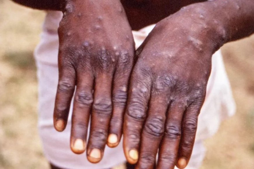 TURASABWA KUBA MASO! RBC Yatangaje ko abarwayi babiri aribo bagaragayeho Ubushita bw’Inkende buzwi nka Monkeypox hano mu Rwanda