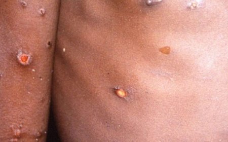 Ibisubizo by’ibibazo byose wibaza ku cyorezo cy’ubushita bw’inkende (MONKEYPOX)