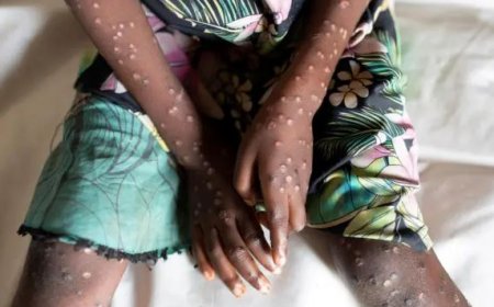 Icyorezo cya MONKEYPOX (Ubushita bw’inkende)  cyageze muri Uganda