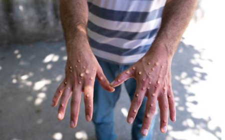 Kamwe  Mu turere tw'intara y'iburasirazuba hagaragaye Abantu babiri banduye icyorezo cy’ubushita bw’inkende