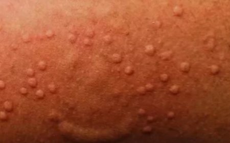 Icyorezo gihangayikishije isi kiri kubaga ntakinya mugihugu cya Congo