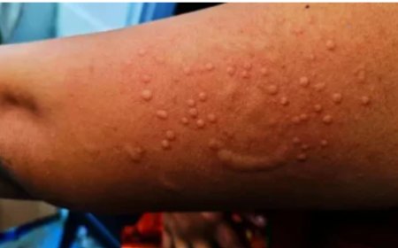 Indwara y’Ubushita bw’inkende imaze kuba icyorezo ku rwego rwa Afurika-OMS