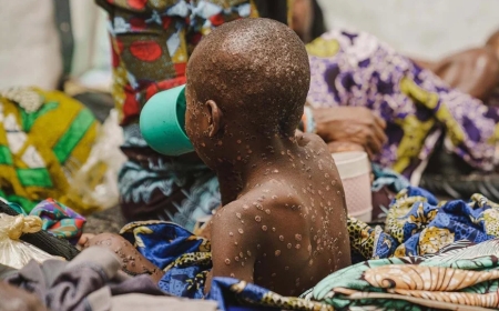 RDC: Inzara iravuza ubuhuha igatuma abarwaye Ubushita bw’Inkende bagatoroka ibitaro