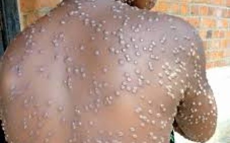 OMS yatangaje igihe icyorezo cy’ubushita bw’inkende cyizaba cyahagaritswe