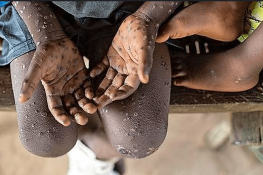 Icyorezo gikomeje kuvuza ubuhuha mu bihugu bitandukanye kugeza nubwo ubungubu cyageze muri Kenya