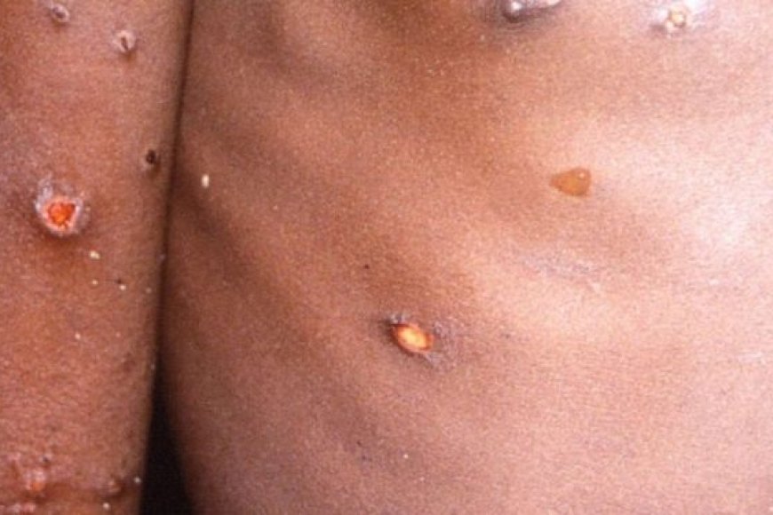 OMS yagize icyo itangaza ku ndwara y’ubushita bw’inkende muri Afurika