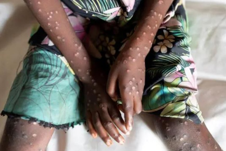 Ubutumwa bugenewe Abaturarwanda ku gushyiraho uburyo bwo guhangana n’ubushita bw’inkende buhangayikishije EAC