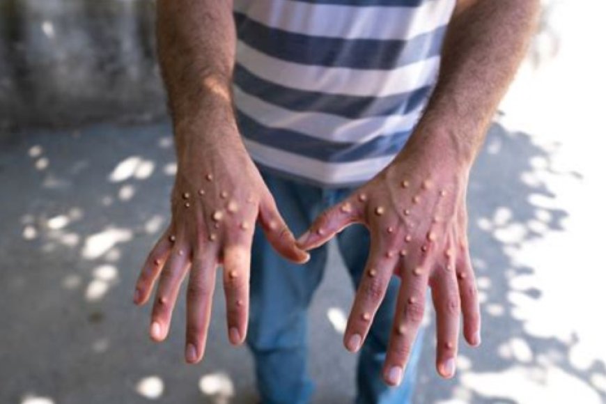 UBUZIMA: #MINISANTE yatanze impuruza ku cyorezo cy'Ubushita bw’inkende Inavuga nibyo utarukiziho- Soma usobanukirwe