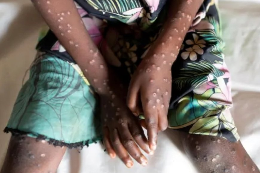 Dore icyo basabye Abakora ingendo za hato na hato kugira ngo dukumire icyorezo cy'ubushita bw'inkende