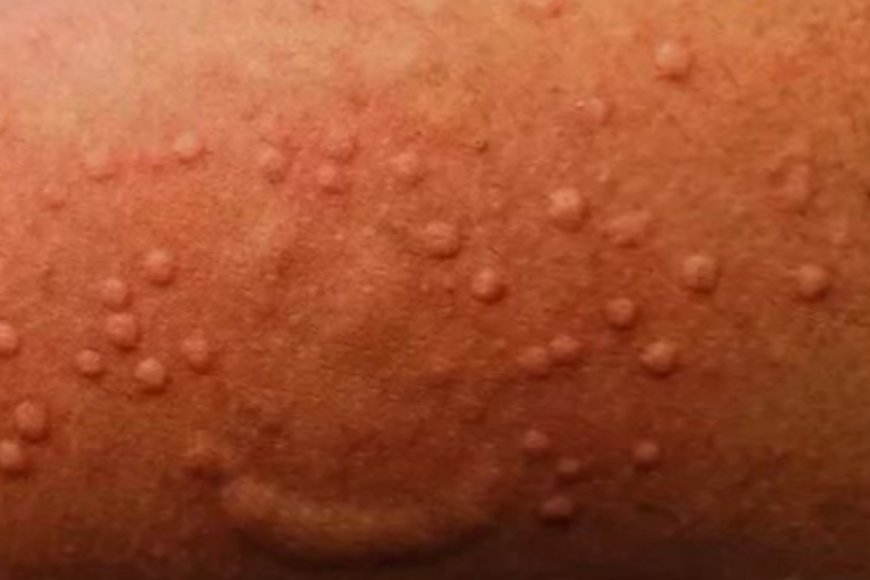 Icyorezo gihangayikishije isi kiri kubaga ntakinya mugihugu cya Congo