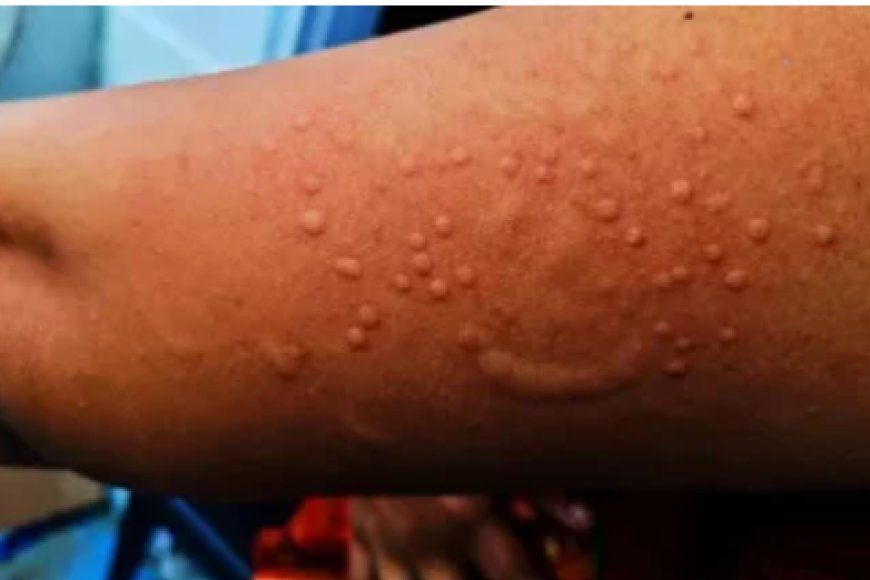 Indwara y’Ubushita bw’inkende imaze kuba icyorezo ku rwego rwa Afurika-OMS