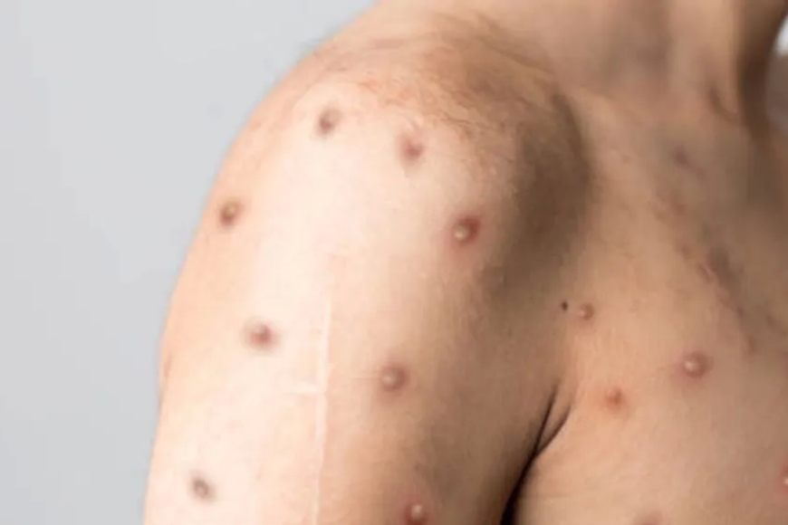 Indwara ikomeje gutitiza abatuye isi nyuma yuko igaragaye no mu bihugu by'i Burayi