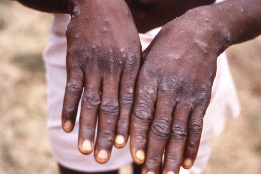 Hatangajwe amakuru y’uko icyorezo cy'Ubushita bw'Inkende gihangayikishije Isi cyifashe mu Burundi