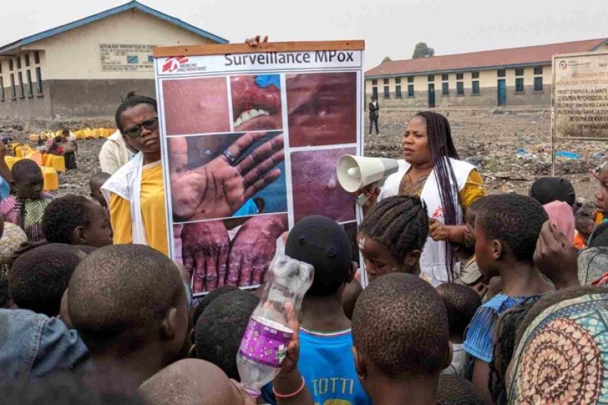 Icyorezo n'inzara birimo kuvuza ubuhuha muri Congo kubera abarwayi ba ‘Monkeypox’ bari gutoroka ibitaro kubera inzara