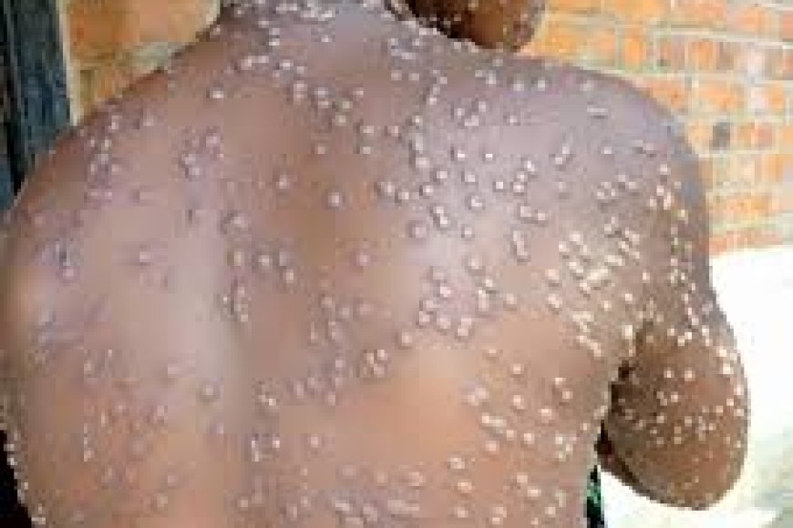 OMS yatangaje igihe icyorezo cy’ubushita bw’inkende cyizaba cyahagaritswe