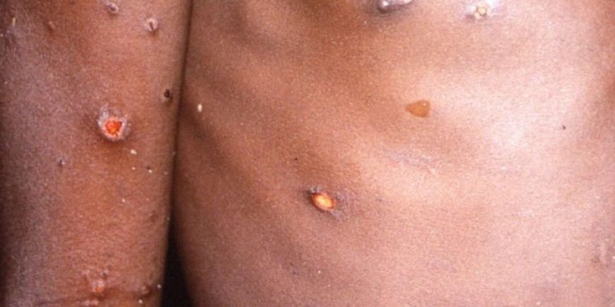 Ibisubizo by’ibibazo byose wibaza ku cyorezo cy’ubushita bw’inkende (MONKEYPOX)