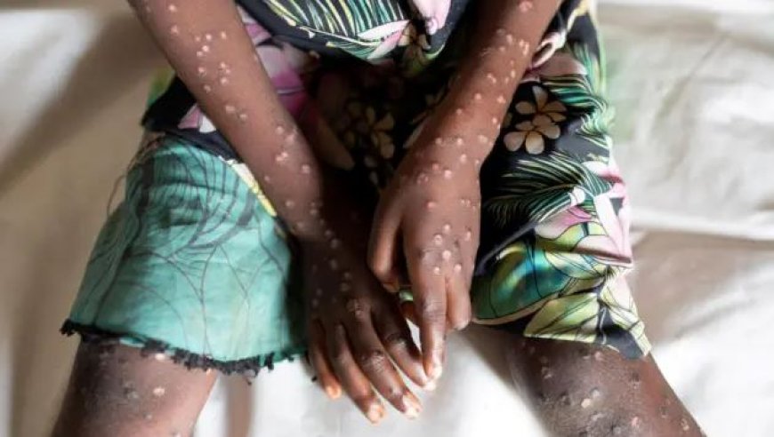 Ubutumwa bugenewe Abaturarwanda ku gushyiraho uburyo bwo guhangana n’ubushita bw’inkende buhangayikishije EAC