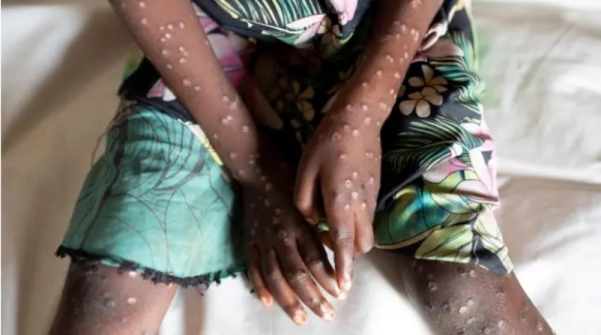 Dore umubare w'abarwayi b’ubushita bw’inkende   bamaze kugaragara   Mu Rwanda