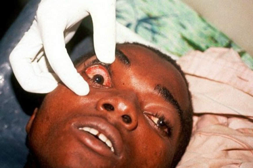 Amerika yoherereje u Rwanda inkingo n’imiti bya Marburg mu rwego rwo guhangana n’iyi ndwara