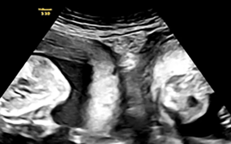 Umugore waremanywe umwihariko wo kugira nyababyeyi ebyiri yabyaye abana b’impanga buri wese yarakuriye mu ye