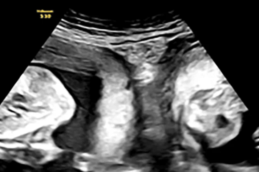 Umugore waremanywe umwihariko wo kugira nyababyeyi ebyiri yabyaye abana b’impanga buri wese yarakuriye mu ye