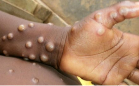 Dore umubare wabandura Mpox bayikura mu mibonano mpuzabitsina