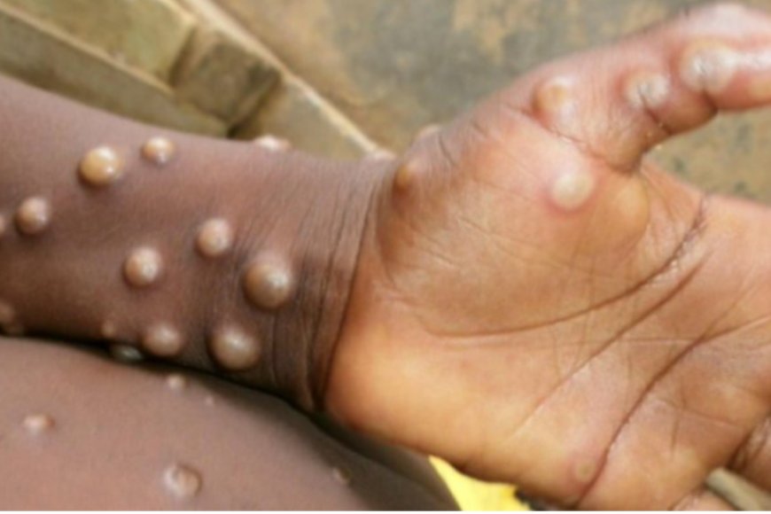 Dore umubare wabandura Mpox bayikura mu mibonano mpuzabitsina