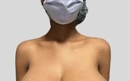 Umukobwa ari mugahinda gakomeye nyuma yuko yatewe urukingo rwa COVID-19 amabere ye akaba manini kuburyo yikubye inshuro 4[AMAFOTO]